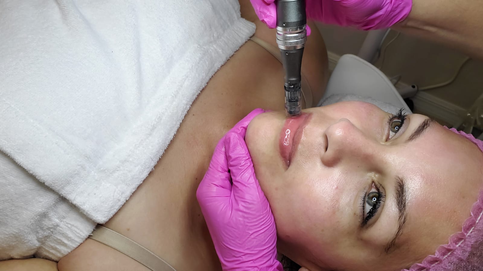 Anahiz Aesthetics skincare treatment result 1
